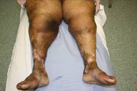 Figure 7 – Lipodermatosclerosis in chronic venous disease